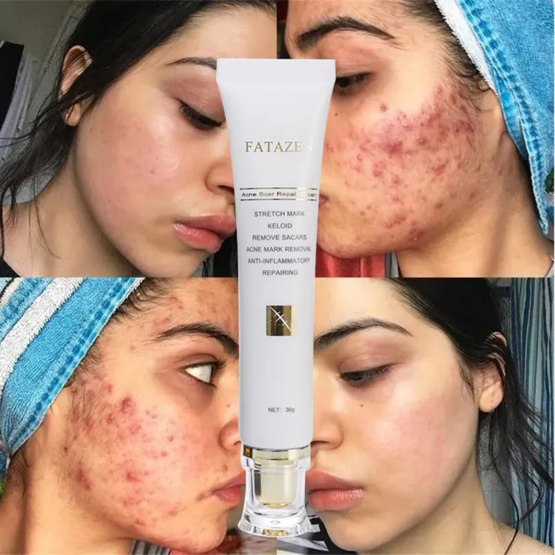 Stretchmarks cream