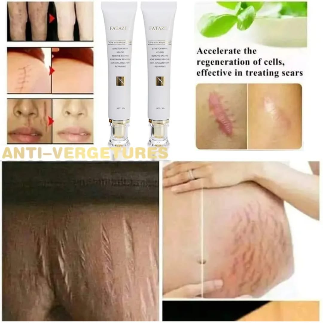Stretchmarks cream
