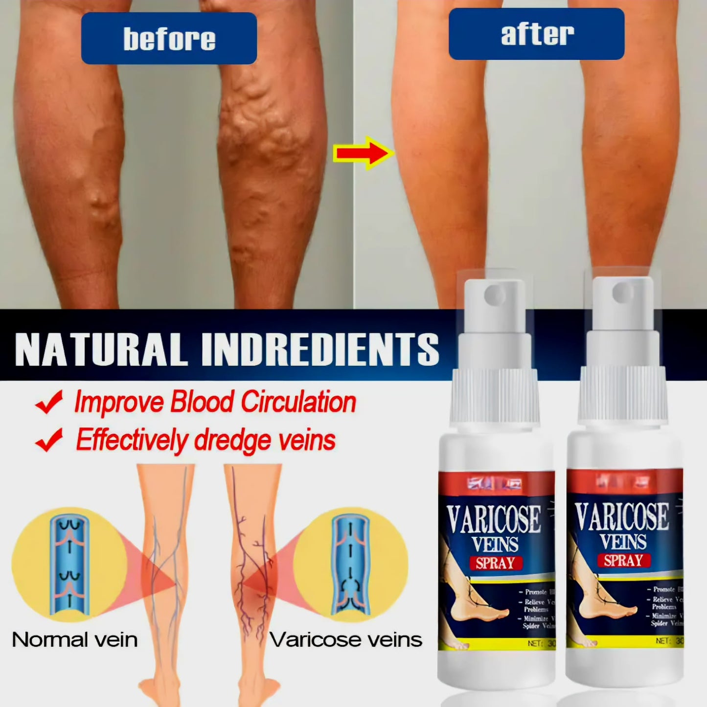 Varicose veins spray