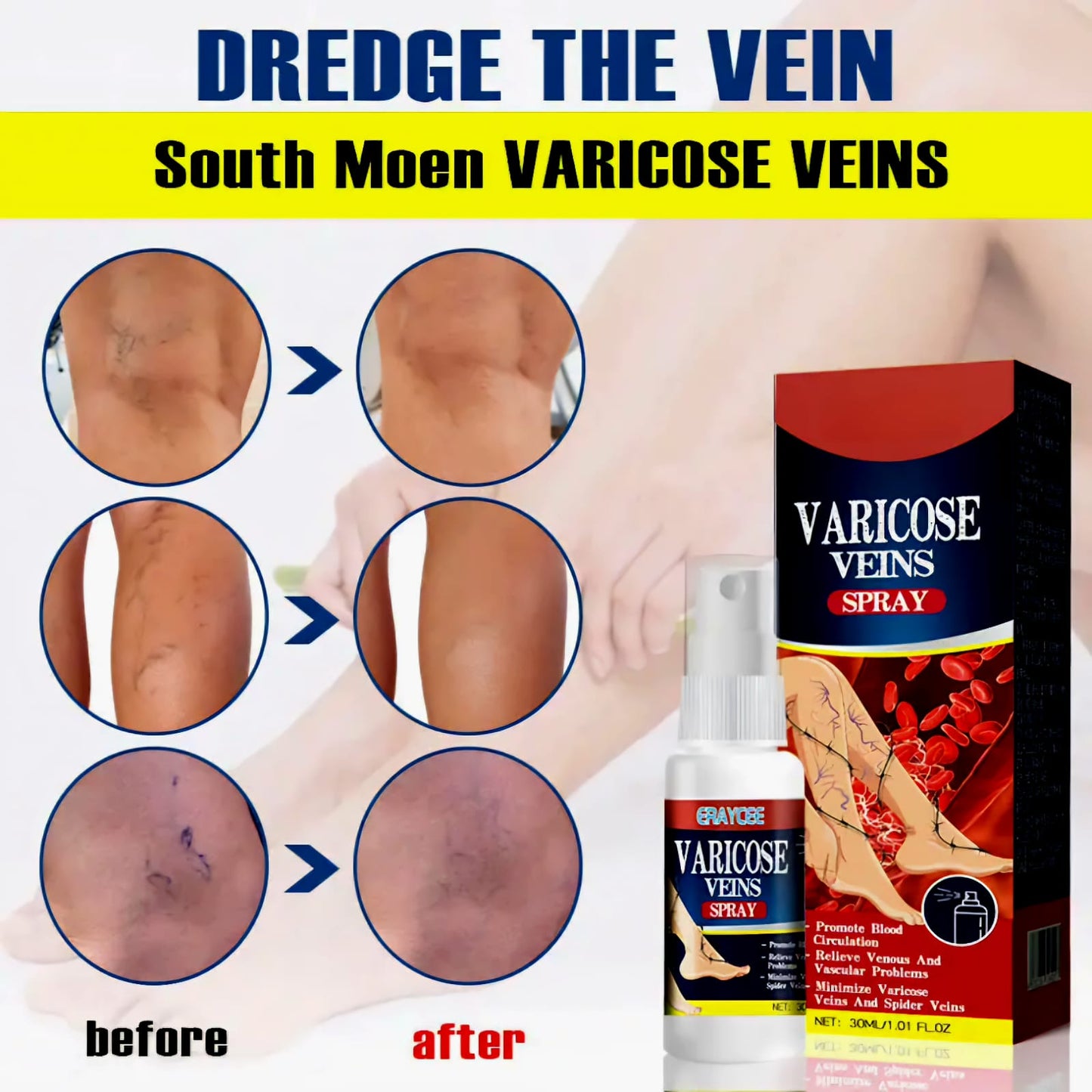 Varicose veins spray